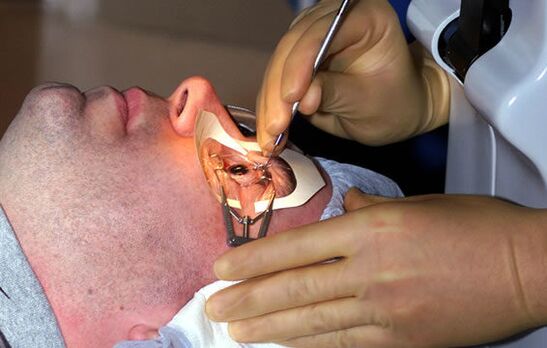 Scleroplastie pentru miopie pentru stabilizarea vederii