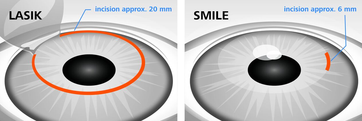 Comparația metodelor de corectare a vederii cu laser LASIK și SMILE